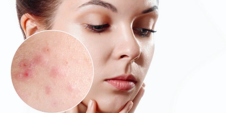 Róża z kolcami – skąd się bierze trądzik różowaty?