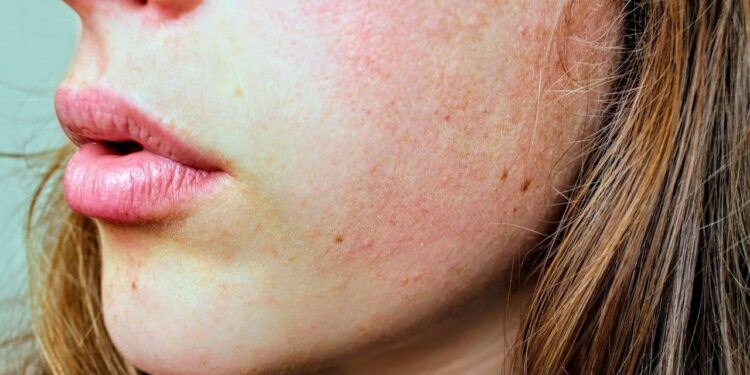 mezoterapia zabieg kosmetyczny