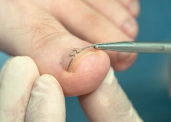 rekonstrukcja paznokcia