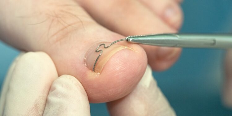 rekonstrukcja paznokcia