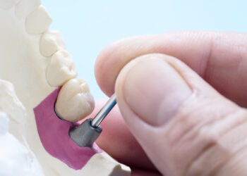 alternatywy protez zebowych