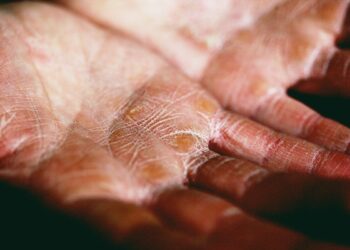 Dłoń dotknięta egzemą